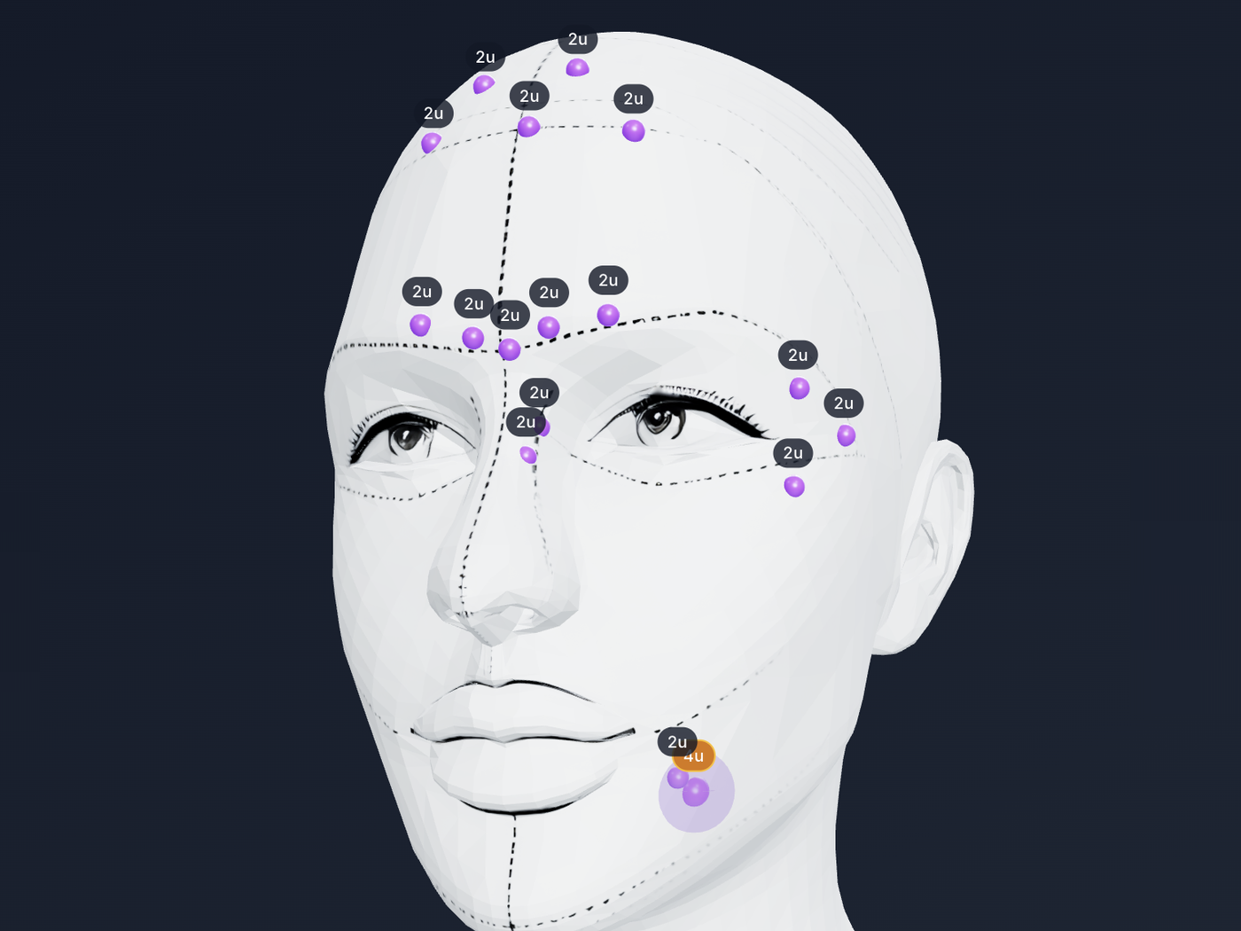 Dalphene 3D face chart on an iPad — injection points mapped with units per site